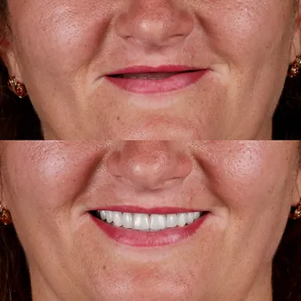 імплантація зубів в Одесі, яку пропонує клініка https://brillant.dental/